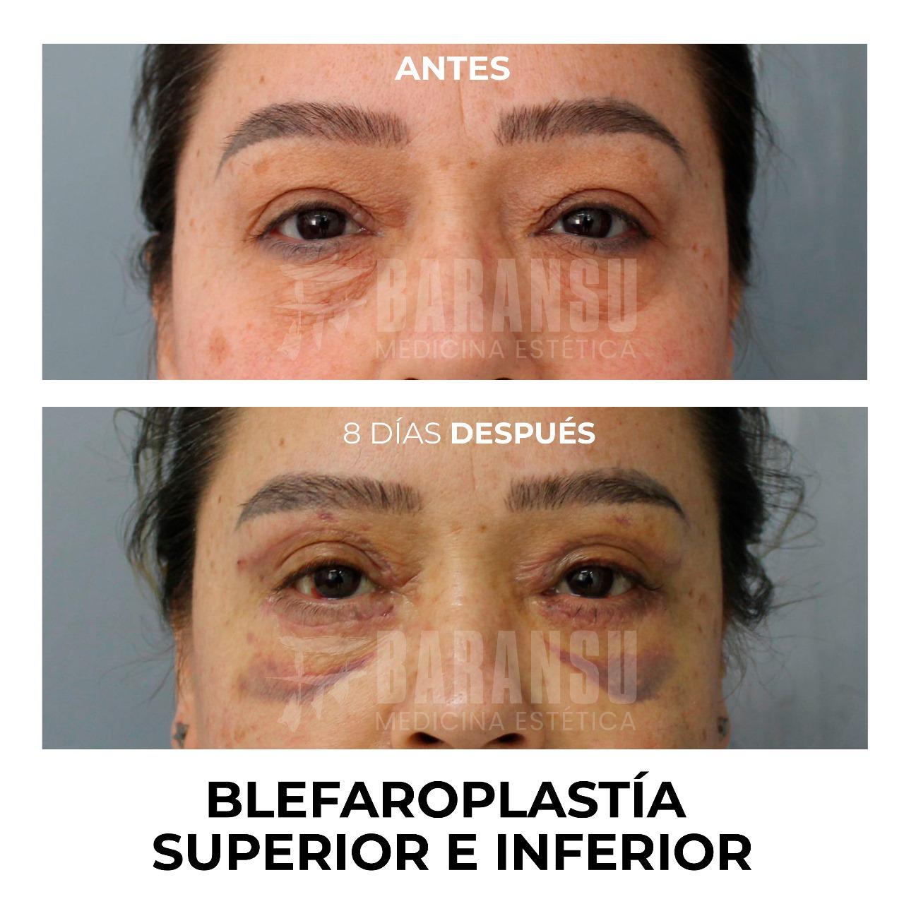 blefaroplastia 35