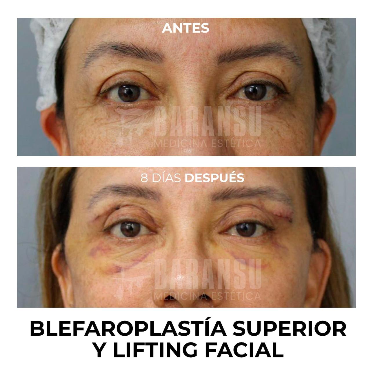 blefaroplastia 36