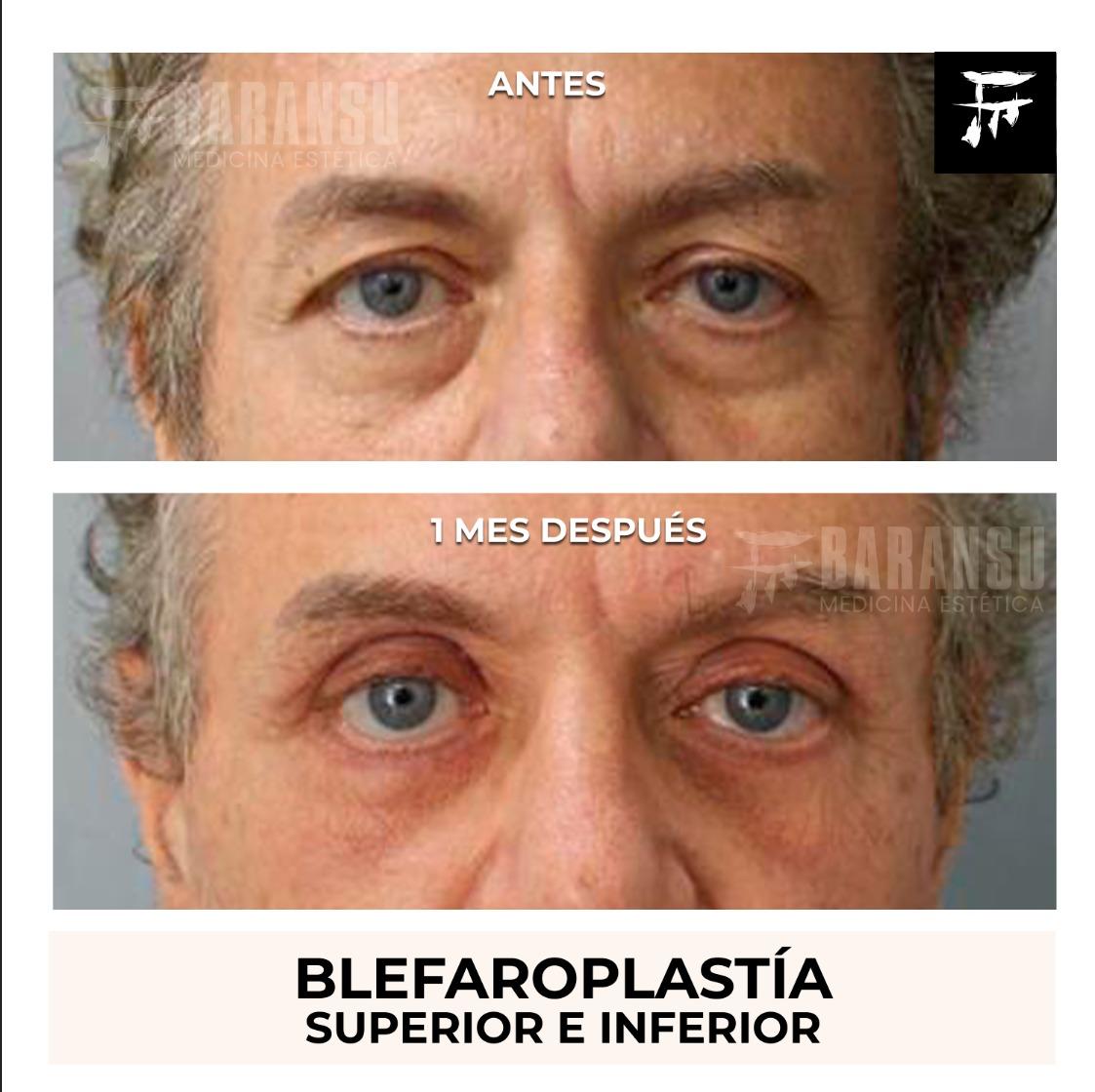 blefaroplastia 37