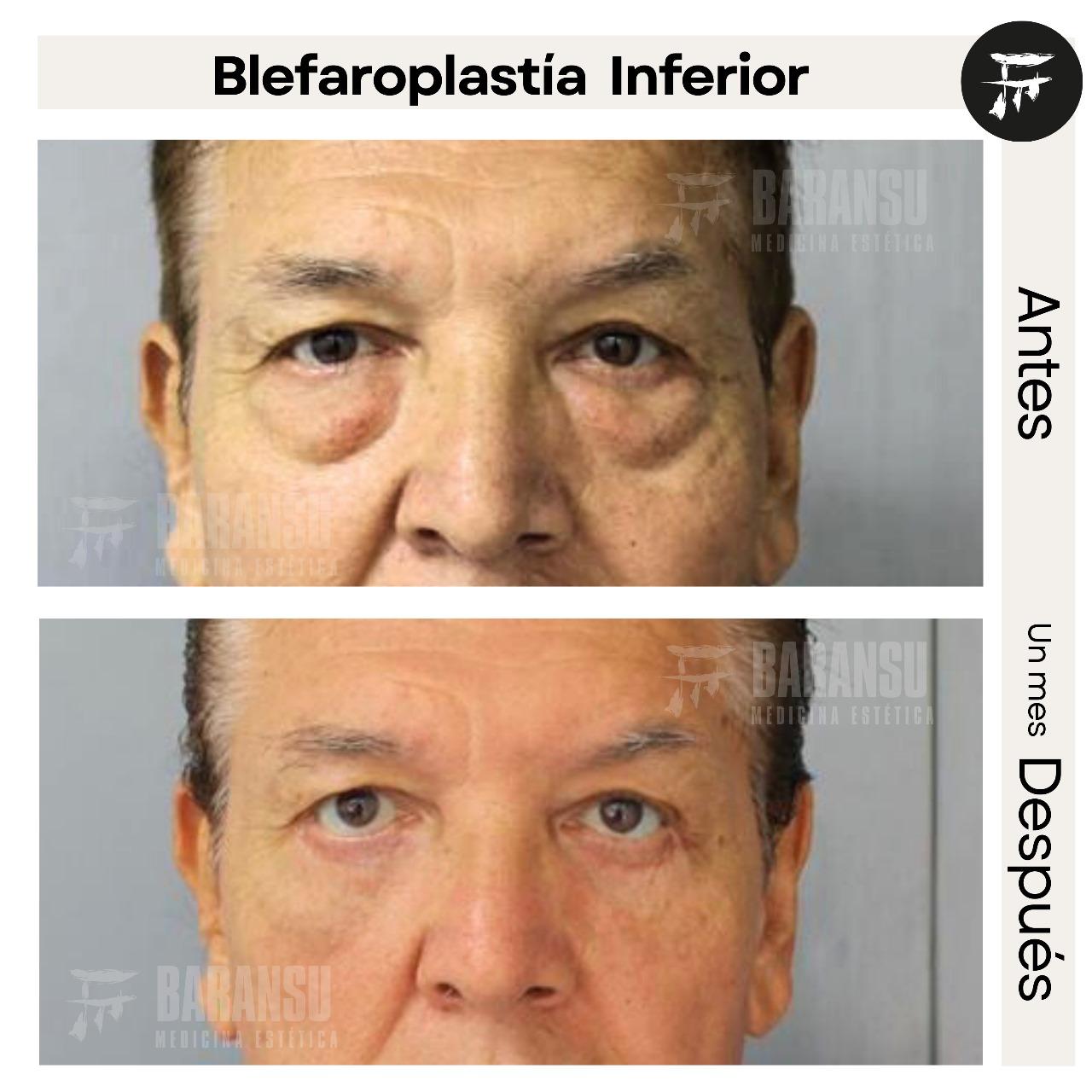 blefaroplastia 38