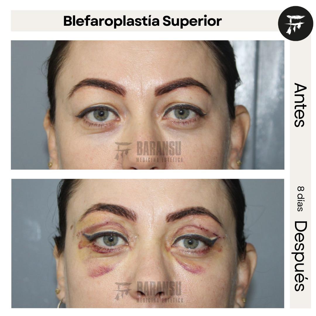 blefaroplastia 39