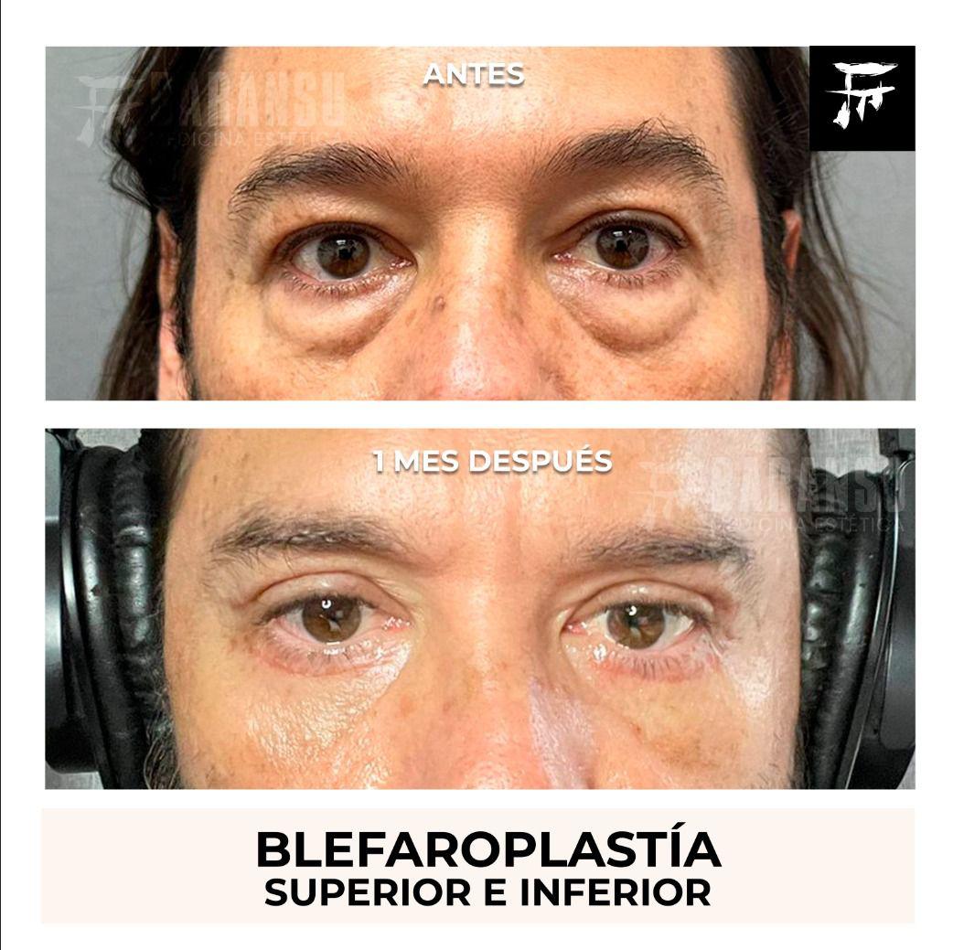 blefaroplastia 40